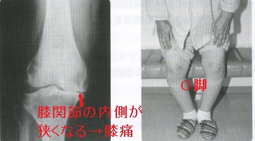 高齢者の膝関節疾患